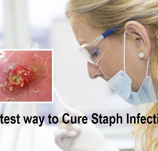 Fastest way to Cure Staph Infection