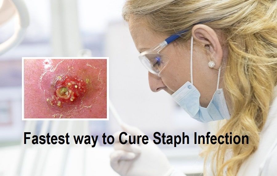 Fastest way to Cure Staph Infection