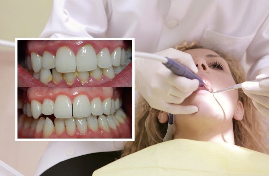 Remove Tartar And Plaque From Your Teeth